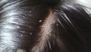 How to remove dandruff