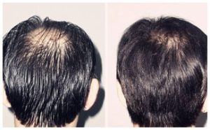 How to treat hair loss after hair coloring How to do after hair loss