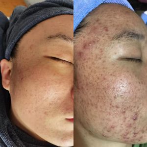 What are the recommendations of effective acne products -2023 effective acne products brand ranking