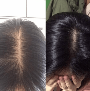 What about severe hair loss in women? Can hair loss improve every day