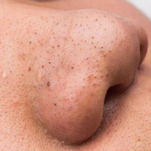 Blackhead acne can squeeze the harm of squeezing by hand